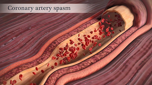 冠状动脉抽搐是这些动脉之一的短暂 突然缩小心脏病学科学药品疾病油炸心血管牌匾攻击肥胖中风背景图片
