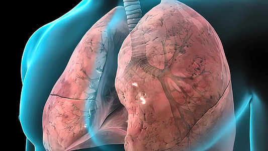 3D为呼吸系统问题 癌症医疗或健康问题提供例证 c 肺部受损药品生物学诊所疾病细胞卫生保健诊断呼吸科学图片