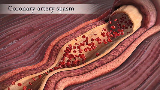 疏通血管冠状动脉抽搐是这些动脉之一的短暂 突然缩小饮食细胞危险动脉粥样硬化心血管营养肥胖血块凝块医学背景