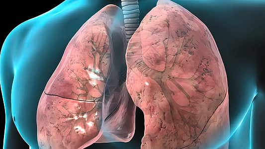 3D为呼吸系统问题 癌症医疗或健康问题提供例证 c 肺部受损身体科学解剖学扫描危险细胞卫生x光哮喘感染图片