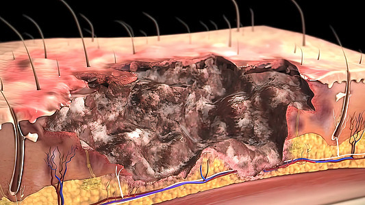 第一度烧焦皮层 3d抗生素药品真皮凝胶烧伤症状起泡火焰剥皮伤害图片