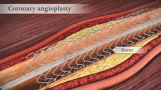 冠状血管成形器打开了较窄的冠状动脉危险药品中风动脉粥样硬化动脉医学细胞饮食肥胖心血管图片
