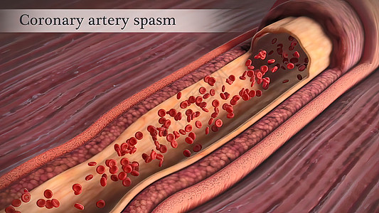 冠状动脉抽搐是这些动脉之一的短暂 突然缩小血块动脉硬化凝块肥胖动脉粥样硬化科学心脏病学血管危险饮食图片