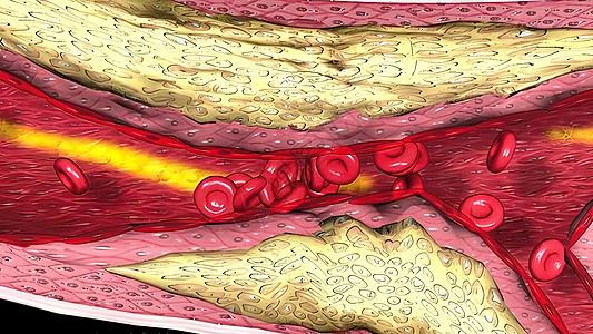 显微摄影显示含有胆固醇的凝固性醇斑块化学插图血流教育凝块红细胞人体生理细胞插头图片