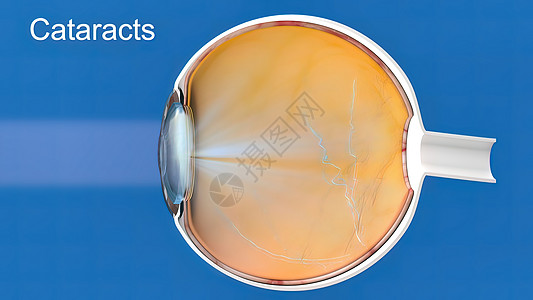 白内障 蒙上眼睛的透镜 导致视力下降瞳孔解剖学超声显微镜角膜巩膜眼科眼球外科乳化图片