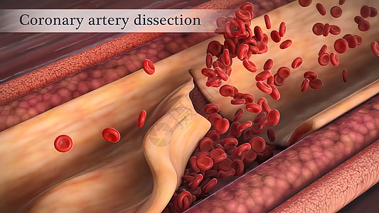 冠状动脉抽搐是这些动脉之一的短暂 突然缩小动脉硬化科学血块心血管血管凝块封锁油炸攻击危险图片