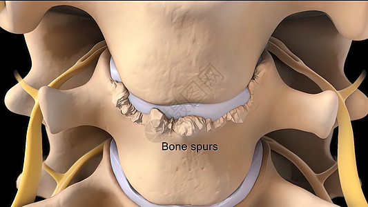 骨关节炎引起的关节损伤是骨刺的最常见原因解剖学治疗磁盘人体考试疗法身体鞭策运动软骨图片