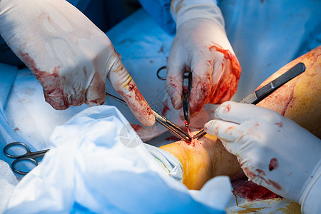 血管外科医生正在切除血管静脉 以便进行变形手术疼痛血栓蜘蛛毛细血管静脉曲张身体皮肤浮肿治疗病人图片