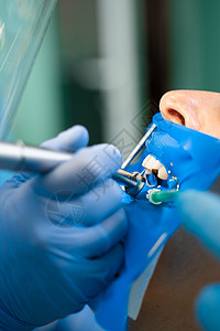 牙科治疗在口腔病学中是牙医学 牙医用牙科大坝隔离牙齿口腔科矫正药品钻头口服工具医生运河手术临床图片