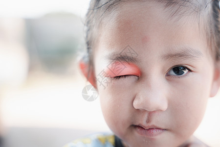 闭闭闭亚洲小屁孩 小姑娘眼睛和Sty眼皮眼科孩子疾病皮肤脓肿粮食女孩药品配镜师图片