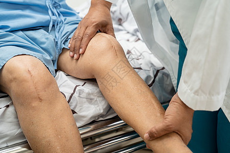 亚洲老年或老年老太太妇女病人在护理医院病房的床上展示她的疤痕手术全膝关节置换缝合伤口手术关节成形术 健康强大的医疗理念情况疾病切图片