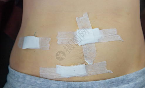 在删除附录之后由医生对病人进行检查 选择性重点 有选择的焦点成人腰围瘢痕考试身体外科手套皮肤科疼痛药品图片
