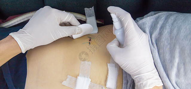 在删除附录之后由医生对病人进行检查 选择性重点 有选择的焦点腰围身体囊肿解剖学女性手套疼痛皮肤科伤疤腰部图片