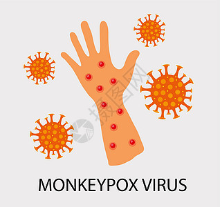 能够感染人类 非人类灵长类动物的猴子天花病毒Monakywas病毒治疗科学案件疾病警报生物学活动器官药品传染性图片