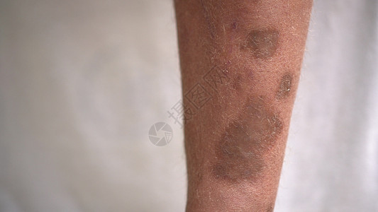 人腿上染色斑点和溃疡 在变形血管手术后为人皮肤发炎 白皮下为人长腿图片
