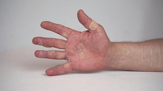 近距离 用二等热水烧一个人的手 皮肤肿胀 发泡剂手指伤害皮革瘢痕烫伤痛苦润滑帮助损害医院图片
