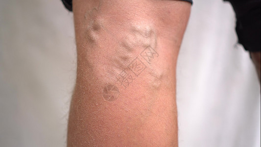 在腿部男性的皮肤下 可以看到血管变异图片