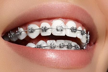 有牙套的美丽的白牙 牙科护理照片 女人微笑与矫形配饰品 整形治疗诊所矫正牙齿女孩口腔科嘴唇陶瓷金属女性牙医图片