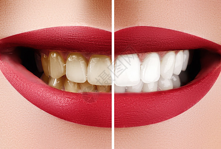 白前和白后女性牙齒封闭宏 牙科保健和口腔保健概念 与红嘴笑的快乐微笑图片