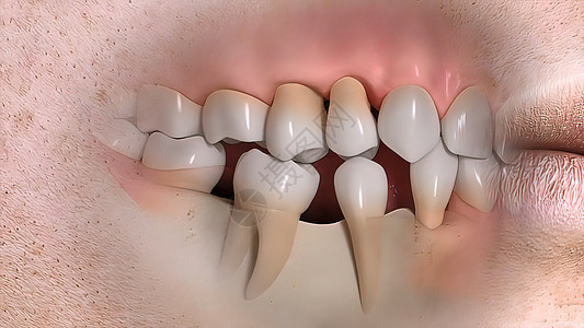 牙齿结构的破坏 现实的医疗动动动口腔乳房假肢牙科教学窗户办公室医学牙医科学图片