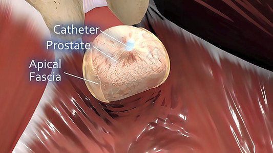 男性生殖器官3D说明解剖药品泌尿科医疗保险诊所效力肾脏咨询机能考试癌症图片