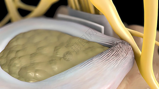 3形成的医疗插图手术骨科髓质外科压力整脊脊髓运河叶片疝气图片