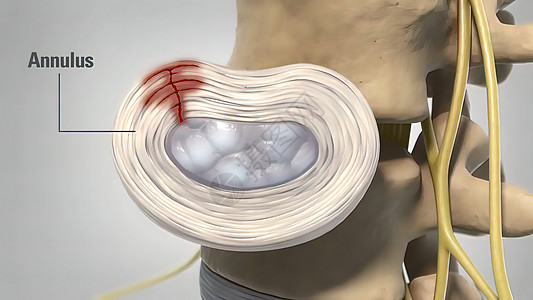 3d 医疗治疗疾病系统脊柱脊髓骨赘状况磁盘神经器官疼痛动画图片