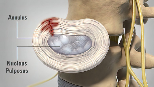3d 医疗治疗疾病动画椎间系统障碍脊髓光盘关节骨头学家椎骨图片