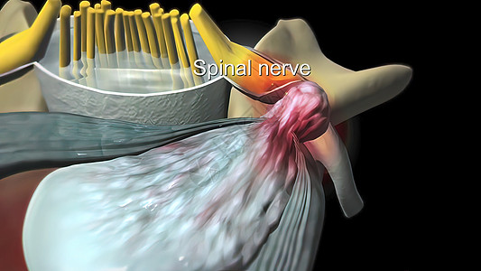 脊椎萎缩 是神经和脊髓通过 的结骨沟渠收缩过程的结果整脊保健卫生症状科学医学考试插图屏幕脊椎图片