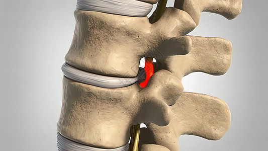 3d 医疗治疗疾病腰椎光盘磁盘骨头系统骨刺关节椎骨骨赘编队图片