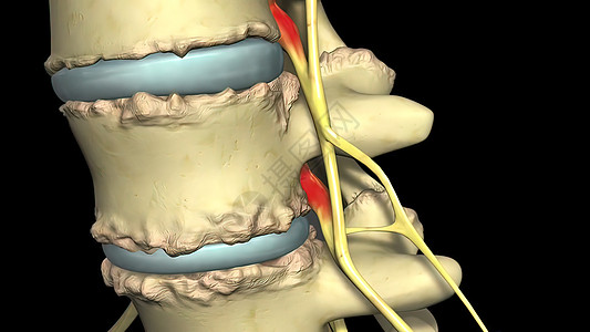 脊椎萎缩 是神经和脊髓通过 的结骨沟渠收缩过程的结果屏幕帮助病理考试医学诊断脱水外科疼痛脊椎图片