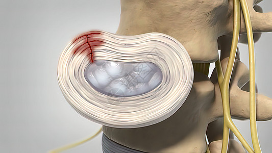 3d 医疗治疗疾病骨刺骨头障碍编队椎间脊柱光盘骨科疼痛椎骨图片
