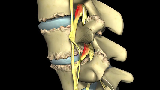 脊椎萎缩 是神经和脊髓通过 的结骨沟渠收缩过程的结果外科诊断身体脱水药品研究椎骨椎间绿色病理图片