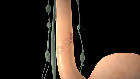 赤道细胞癌     生长的Esophagus肿瘤插图考试药品病痛医院痛苦生物学诊断临床咽喉图片