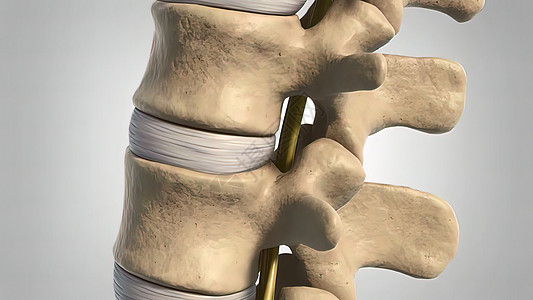 3d 医疗治疗疾病骨刺状况骨赘学家磁盘腰椎障碍骨头脊髓神经图片