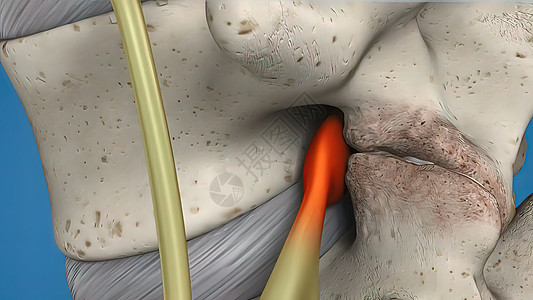 3D 蓝色背景上的脊髓插图 木材切除电外科脊柱医生病人手套手术室医师骨折免费药品图片