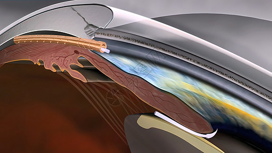 Glaucoma是一种眼睛状况 它损害光神经 对良好的视力至关重要眼镜卫生3d黄斑光学光盘科学眼球鸢尾花肌肉图片