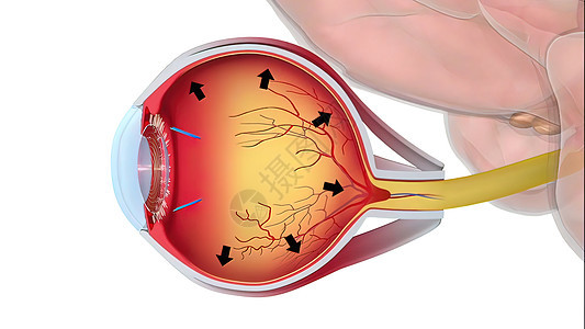 Glaucoma是一种眼睛状况 它损害光神经 对良好的视力至关重要保健教育3d黄斑科学结膜肌肉角膜手表脉络膜背景图片