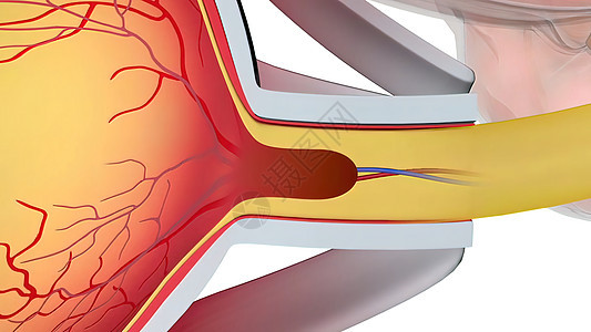 Glaucoma是一种眼睛状况 它损害光神经 对良好的视力至关重要保健光学教育生物学3d卫生手表乐器肌肉药品图片