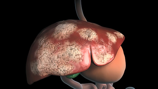 人类肝脏解剖 肝癌症状身体科学生物学癌症肝病解剖学胆囊细胞手术攻击图片