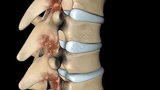 人类脊柱解剖 异形论坛和神经病等细节绳索科学神经身体椎间挑衅生物学手术疾病刺激图片