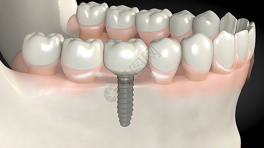 牙科移植手术注射风俗解剖学矫正假牙植入物凹痕陶瓷外科口腔科图片