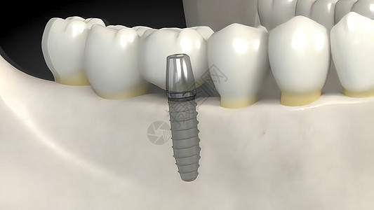 牙科移植手术牙龈风俗组装药品注射推介会口腔科制品解剖学安装图片
