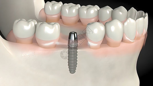 牙科移植手术牙龈组装注射矫正磨牙凹痕推介会治疗药品假肢图片