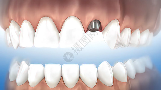 牙科移植手术制品凹痕药品磨牙安装植入物组装推介会牙医牙龈图片