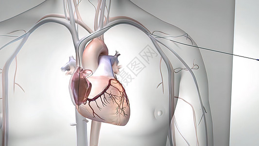 降低死亡风险的外科手术程序 冠状动脉绕行器保健心肌卫生丝绸失败对角线医生机器嫁接收成图片