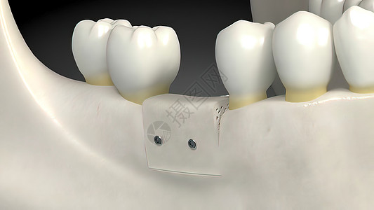 牙科移植手术治疗口腔科插图解剖学矫正搪瓷凹痕风俗外科注射图片