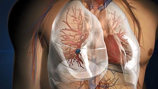 肿瘤在人类肺部形成胸椎哮喘毛细管呼吸道细胞气体插图呼吸系统二氧化碳支气管图片