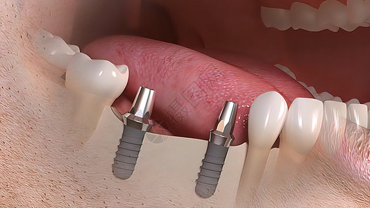 牙科移植手术组装解剖学牙龈插图药品微笑风俗搪瓷牙齿矫正图片