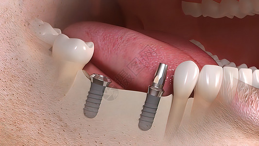 牙科移植手术口腔科凹痕假肢矫正搪瓷注射推介会微笑药品组装图片